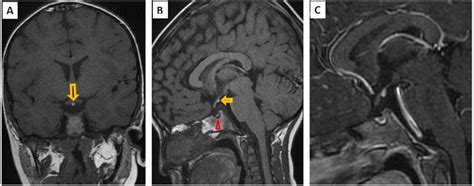 pituitary stalk interruption syndrome|Pituitary Stalk Interruption Syndrome from Infancy to Adulthood .